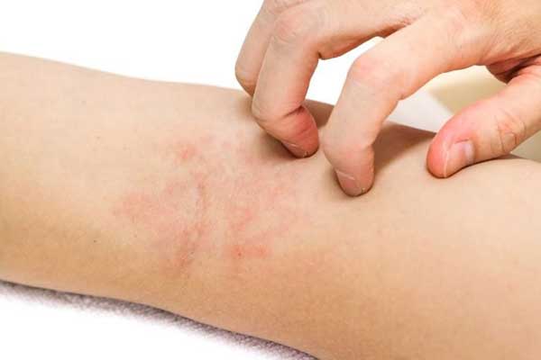 علاج حساسية الجلد والهرش في المنزل