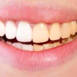أسباب اصفرار الأسنان المفاجئ