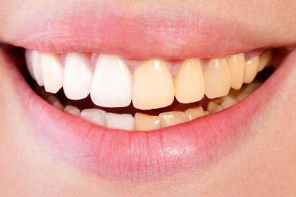 أسباب اصفرار الأسنان المفاجئ