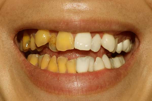 أنواع تصبغات الأسنان – الأسباب و العلاج بطرق حديثة طبية ومنزلية مبتكرة
