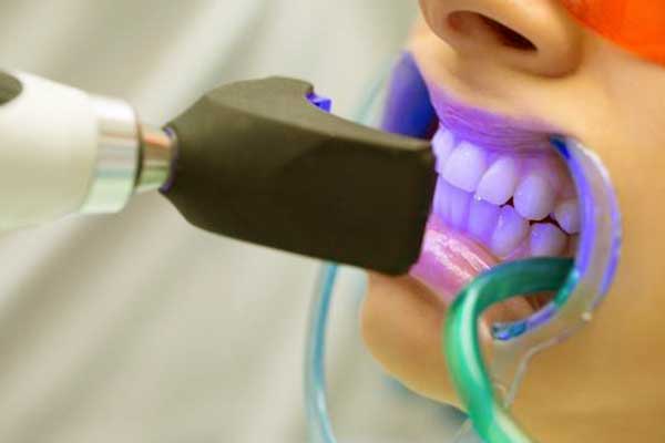 تبييض الأسنان في تركيا – التقنيات و الأسعار و أفضل المشافي