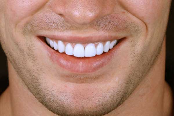 تلبيس الأسنان في تركيا : ابتسامة مشرقة بأناقة تركية