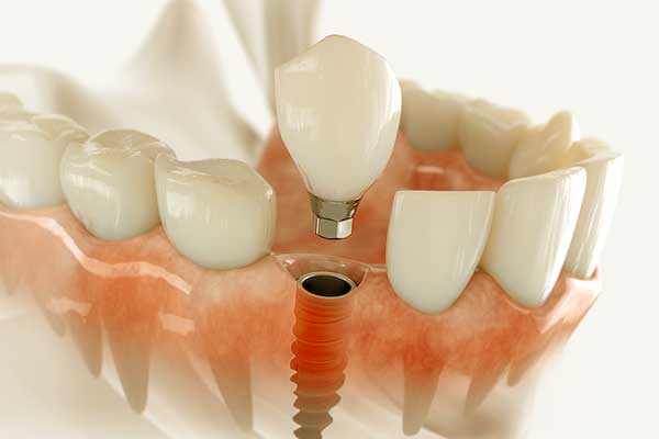 عملية زراعة الأسنان - الخطوات و التكلفة والنتائج