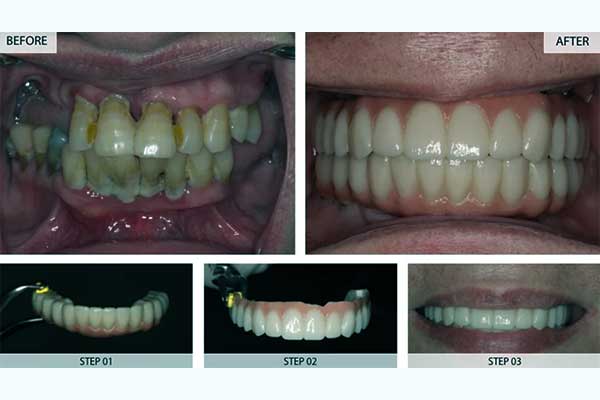 تجارب زراعة الاسنان