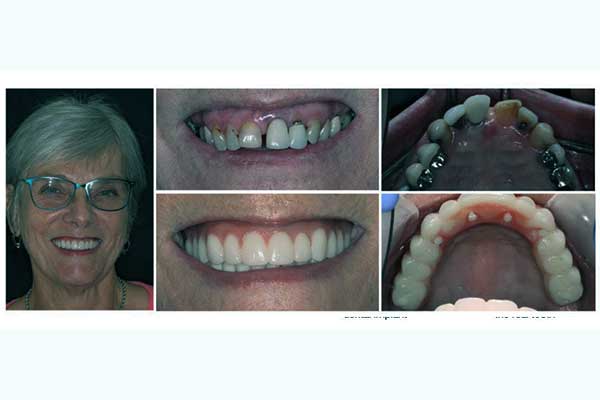 تجارب زراعة الاسنان