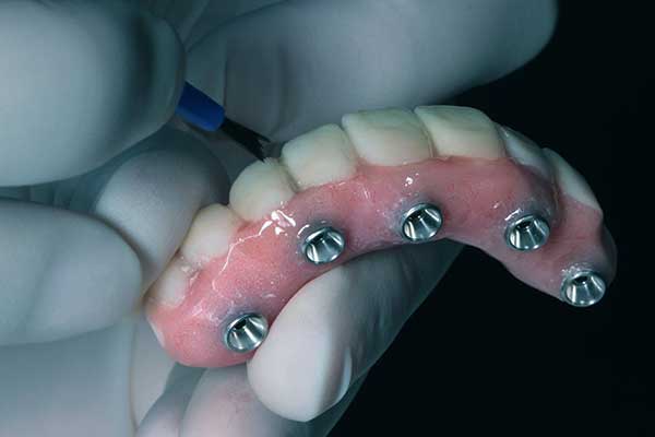 أسعار زراعة الأسنان في قطر – أفضل دكتور وعيادة لزراعة الأسنان