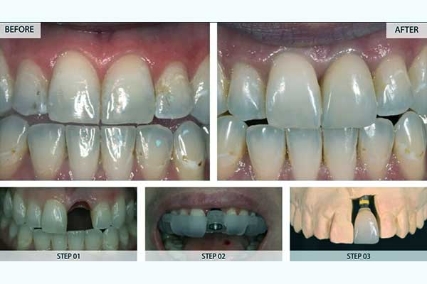 تجارب زراعة الاسنان – نصائح و تعليمات هامة قبل وبعد زرع الأسنان