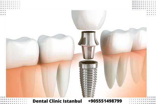 زراعة الاسنان الفورية في تركيا – أهم الفروق و المميزات