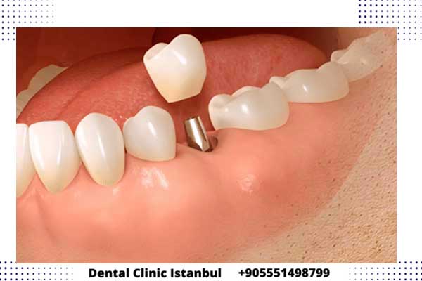 عروض زراعة الأسنان في تركيا – مواعيد ومواسم الخصومات