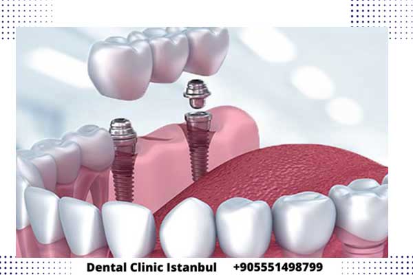 بديل زراعة الاسنان في تركيا – خيارات متنوعة وأسعار مناسبة