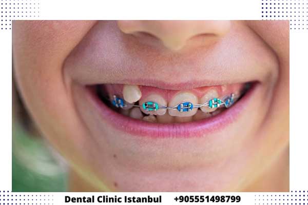 تقويم الاسنان في تركيا – اختر تقويم العلاج المناسب لك
