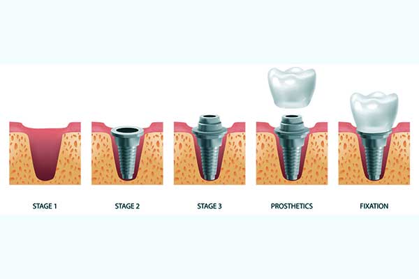مراحل تركيب الاسنان الاصطناعية