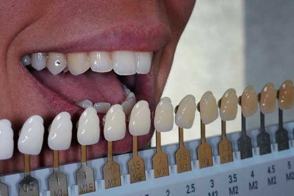أشكال الأسنان الطبيعية - اجمل درجات ألوان الأسنان الطبيعية