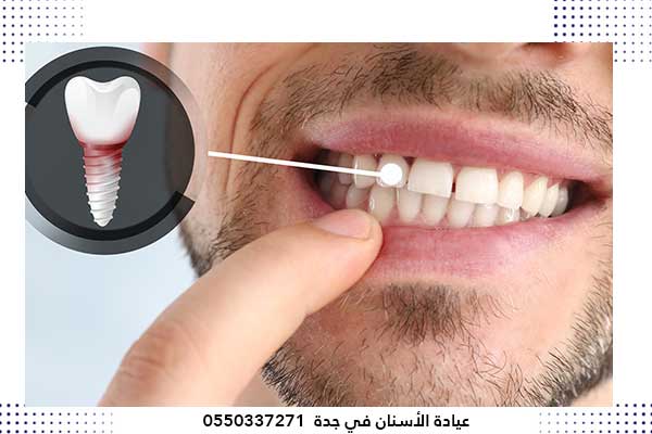 اسعار زراعة الاسنان في جدة -أفضل دكتور وعيادة أسنان بجده