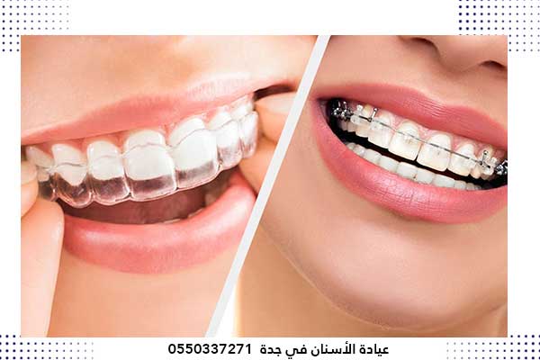 تقويم الاسنان جدة – أفضل دكتور و أرخص عيادة أسنان بجدة