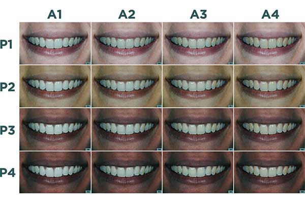 درجات ألوان الأسنان الطبيعية