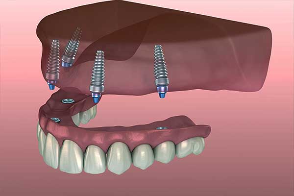 احسن انواع الاسنان الاصطناعية - التركيب والعناية ومواد التصنيع