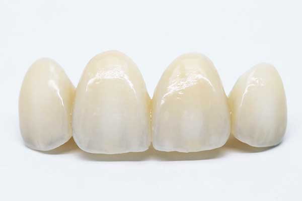 Dental Bridge in Turkey Affordable Solutions for a Beautiful Smile