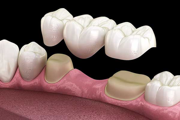 Dental Bridge in Turkey: Affordable Solutions for a Beautiful Smile