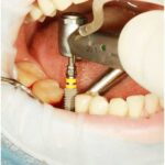 reasons not to get dental implants