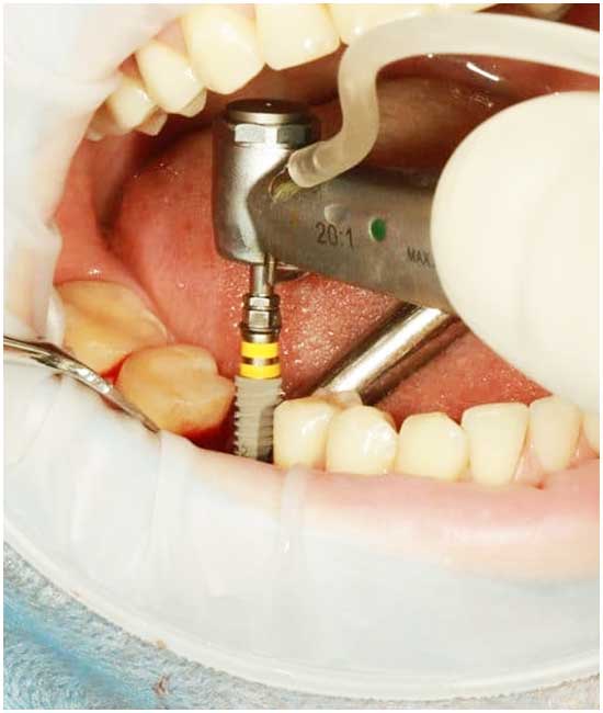 reasons not to get dental implants?