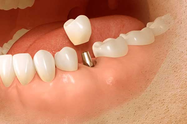 استبدال الأسنان المتعددة