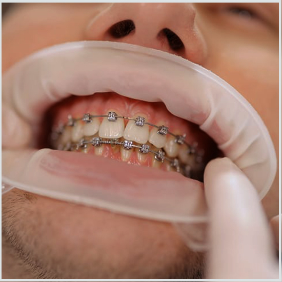 Ortodoncia en Turquía