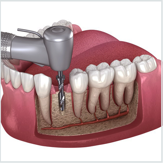 Root Canal Treatment in Turkey
