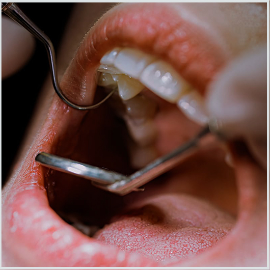 Root Canal Treatment in Turkey