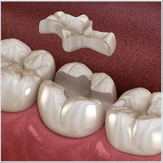 Otturazioni dentali in Turchia