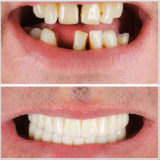 fotos de implantes dentales