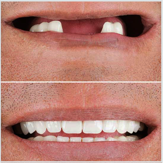 fotos de coronas dentales