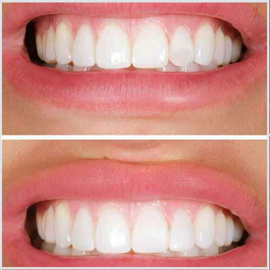 carillas en los dientes antes y después