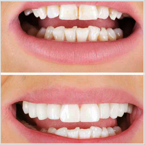 puente de dientes antes y después