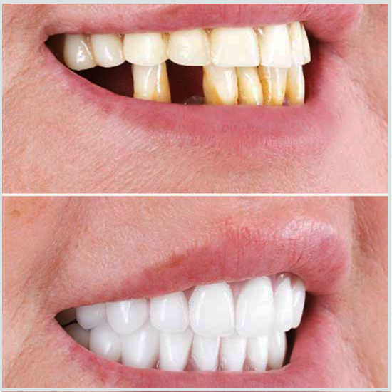 antes y después de las dentaduras postizas