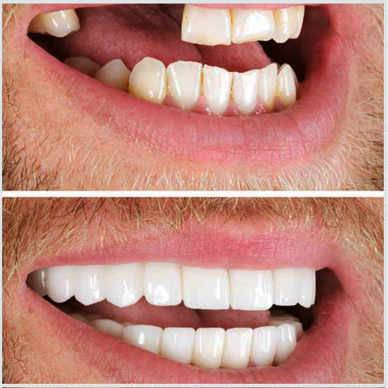 antes y después de los dientes limados
