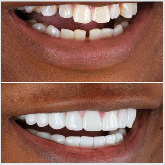 fotos de antes y después de la dentadura postiza