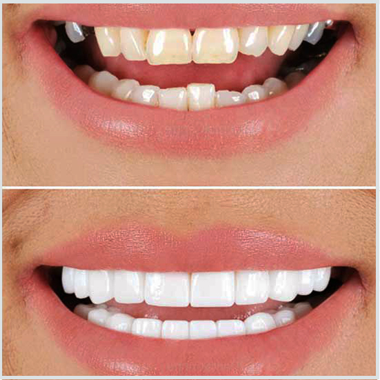 Antes y después del blanqueamiento dental del dentista.