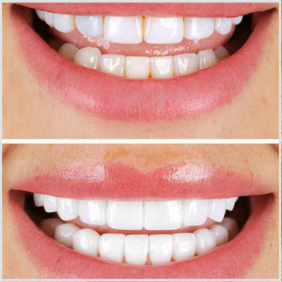 Fotos de antes y después de carillas dentales.