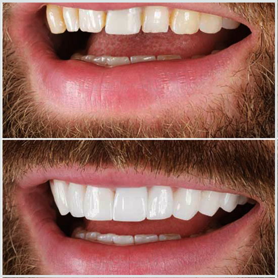 fotos de antes y despues de dientes postizos