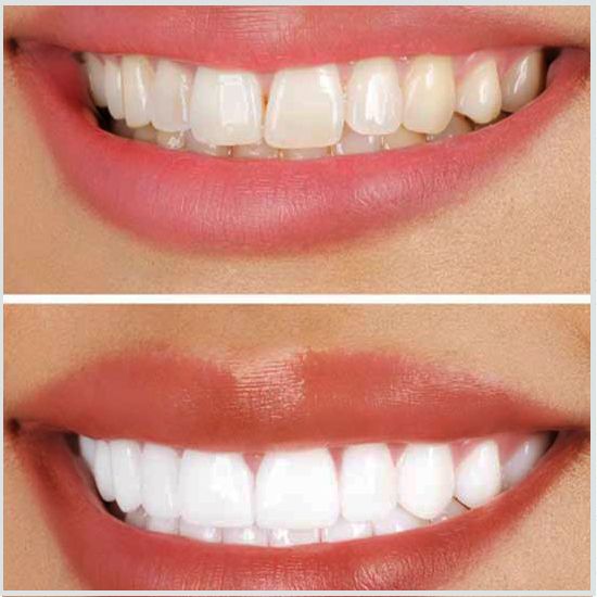 Antes y después de rechinar los dientes