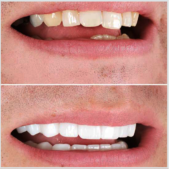 الأسنان الجزئية قبل وبعد