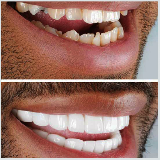 إعادة تمعدن الأسنان قبل وبعد