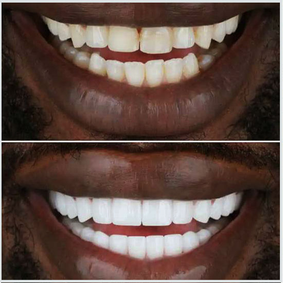 coronas dentales dientes frontales antes y después