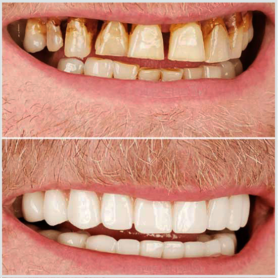 Antes y después de la limpieza dental.