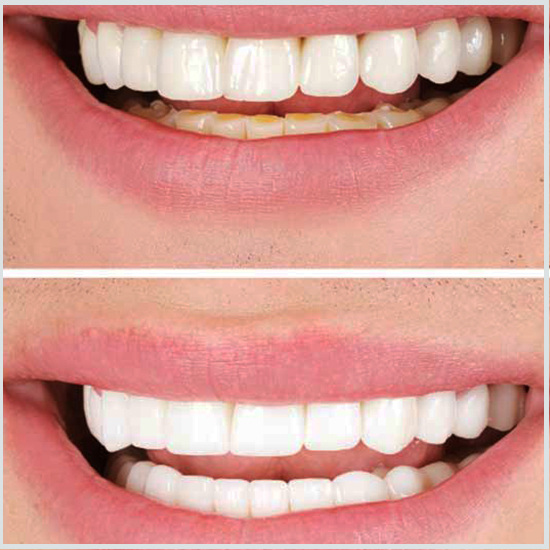 blanqueamiento dental dentista antes y después