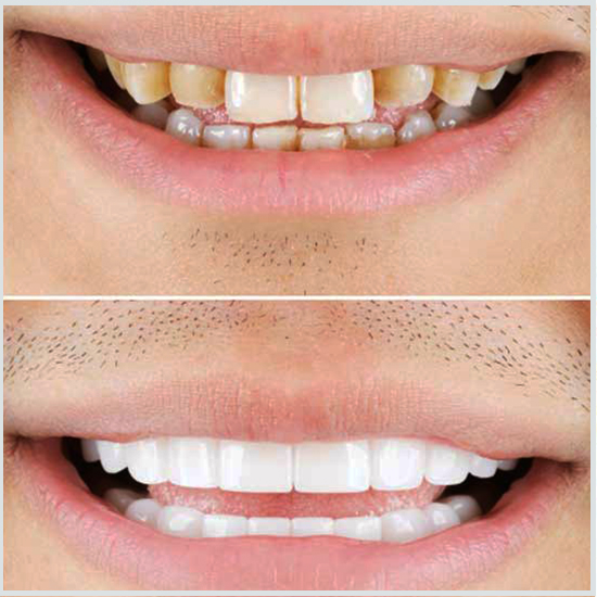 dientes cariados antes y después