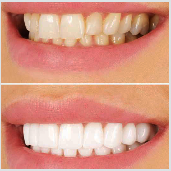 coronas de dientes antes y despues