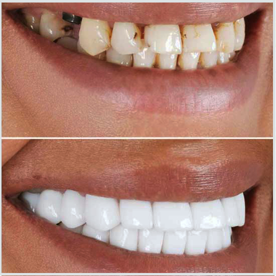 tapas de dientes antes y después