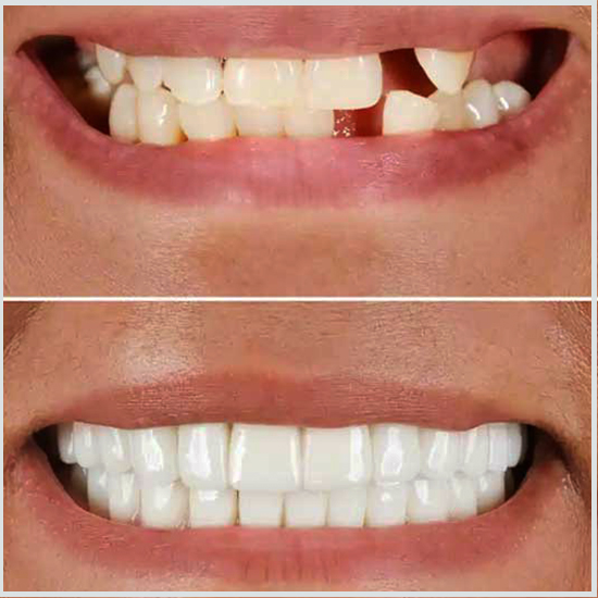 before and after composite veneers
